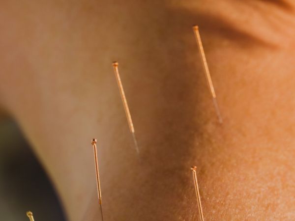 Akupunktur / Akupressur / Elektro­akupunktur